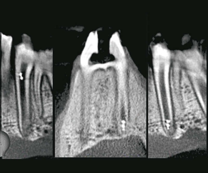 Multiple teeth showing microrobots in the root canal of a tooth.
